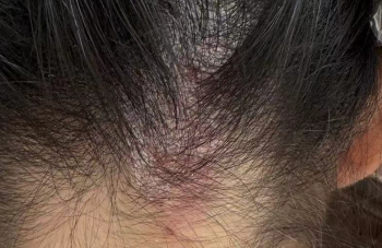 头皮“油”到心慌？脂溢性皮炎引发的脱发危机，这样应对才靠谱！