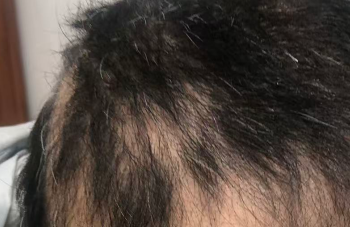 头发越掉越慌？雄激素性脱发可能正在悄悄“盯上”你！