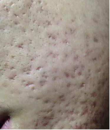 痘印发红了多久会淡化【惠州广肤治疗痘印比较好的皮肤病专科】