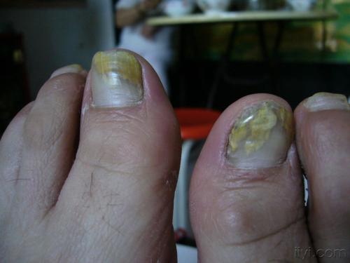 灰指甲真菌病的危害是什么【惠城广肤皮肤病专科】