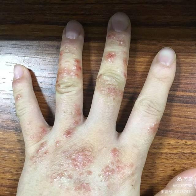 湿疹高发季节要注意什么【惠城广肤皮肤专科中医治疗湿疹】
