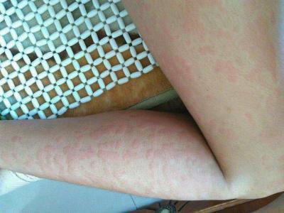 荨麻疹实际都是会导致什么危害【惠城广肤皮肤病专科医院在哪里】