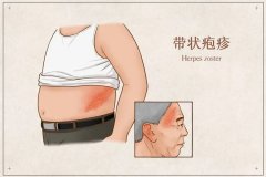 带状疱疹要怎样预防?