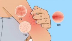 湿疹是什么原因造成的