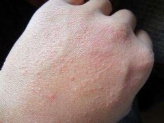 湿疹有哪些危害